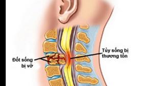 TRIỆU CHỨNG CHÈN ÉP DÂY THẦN KINH VÀ CÁCH ĐIỀU TRỊ BỆNH HIỆU QUẢ